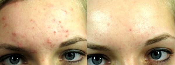 becca-Acne